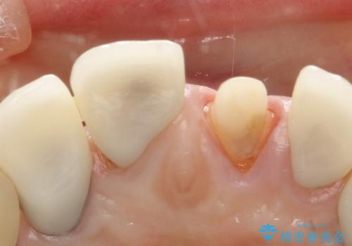 40代女性　「前歯が浮いている」　土台ごと折れた前歯の修復　の治療中