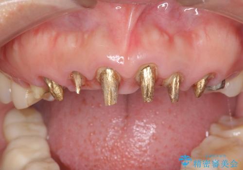 [歯ぐきからの出血]　歯肉の状態を改善する前歯オールセラミック治療①の治療中