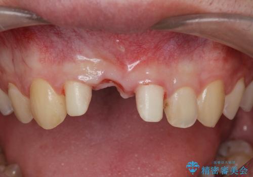 [歯の破折] 歯槽堤保存術を応用した前歯部セラミック治療の治療中
