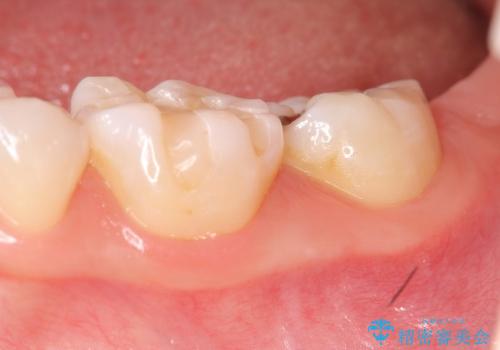 [奥歯を白く]　コンポジットレジン・銀歯のやりかえの治療前