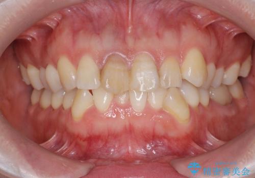 [神経の死んだ歯の変色] 前歯審美セラミック治療の治療前