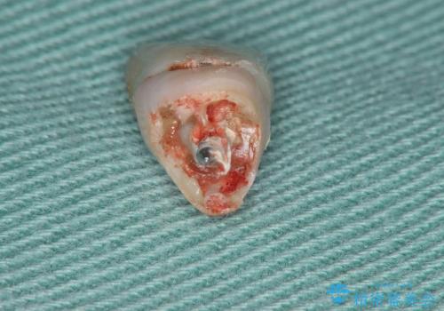 [歯の破折] 歯槽堤保存術を応用した前歯部セラミック治療の治療前