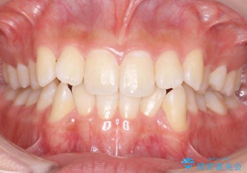 歯を抜かない矯正　インビザラインで　前歯のでこぼこの症例 治療前