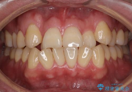 受け口　八重歯　前歯のがたがた　前歯が中に引っ込んでいるの症例 治療前