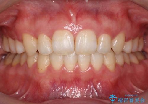 30代女性　出っ歯　奥歯のかみ合わせのずれ　上のみ抜歯の症例 治療後