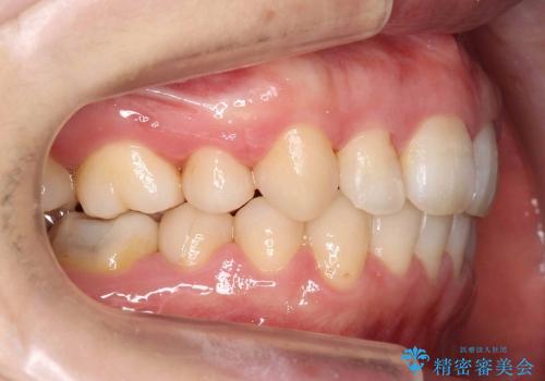 30代女性　出っ歯　奥歯のかみ合わせのずれ　上のみ抜歯の治療後