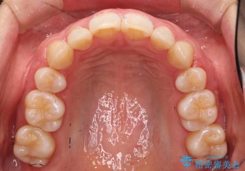 30代女性　出っ歯　奥歯のかみ合わせのずれ　上のみ抜歯の治療後