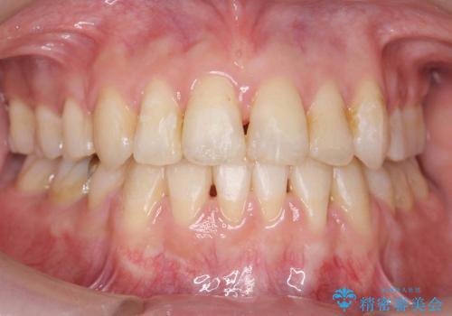20代女性　八重歯　奥歯の反対咬合　前歯のがたがた　急速拡大装置での治療後