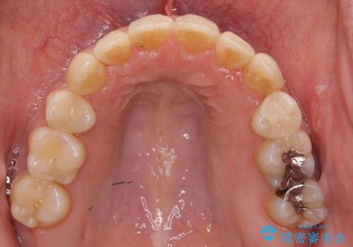 20代女性　八重歯　奥歯の反対咬合　前歯のがたがた　急速拡大装置での治療後