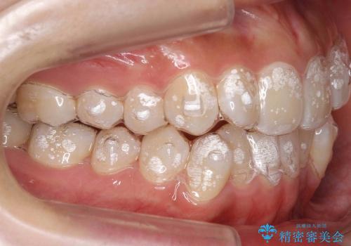 歯を抜かない矯正　インビザラインで　前歯のでこぼこの治療中