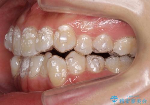 歯を抜かない矯正　インビザラインで　前歯のでこぼこの治療中