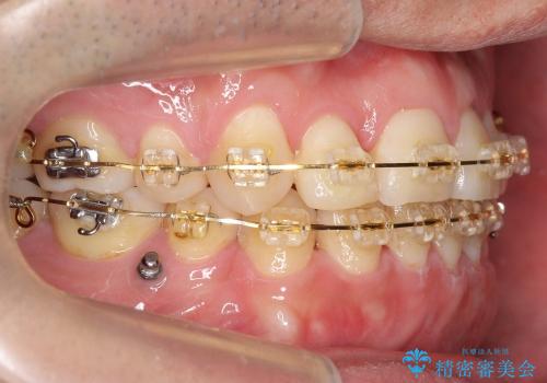 受け口　八重歯　前歯のがたがた　前歯が中に引っ込んでいるの治療中