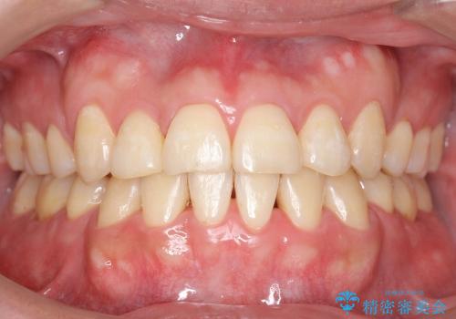 受け口　八重歯　前歯のがたがた　前歯が中に引っ込んでいるの治療後