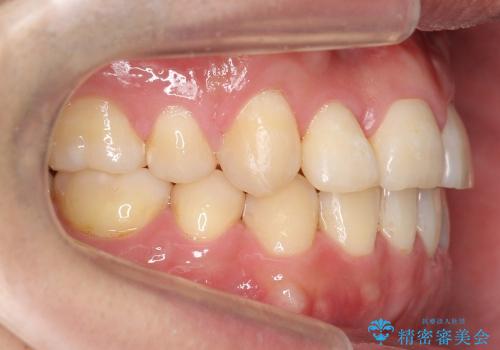 受け口　八重歯　前歯のがたがた　前歯が中に引っ込んでいるの治療後