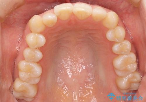 30代女性　出っ歯　奥歯のかみ合わせのずれ　上のみ抜歯の治療前