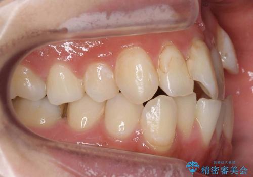 20代女性　八重歯　奥歯の反対咬合　前歯のがたがた　急速拡大装置での治療前