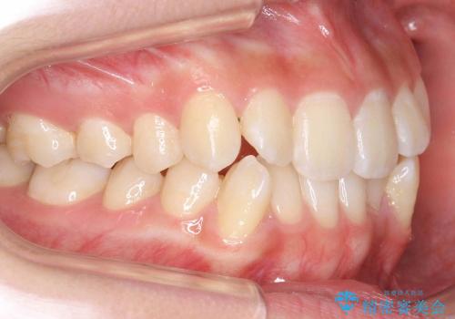 歯を抜かない矯正　インビザラインで　前歯のでこぼこの治療前