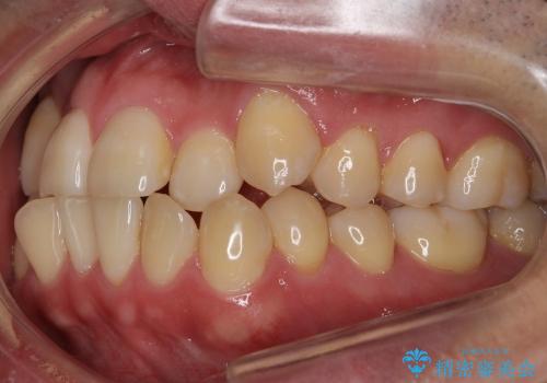 受け口　八重歯　前歯のがたがた　前歯が中に引っ込んでいるの治療前