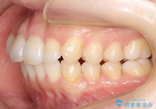 30代女性　出っ歯　奥歯のかみ合わせのずれ　上のみ抜歯の治療前