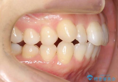 30代女性　出っ歯　奥歯のかみ合わせのずれ　上のみ抜歯