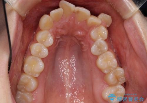 20代女性　八重歯　奥歯の反対咬合　前歯のがたがた　急速拡大装置での治療前