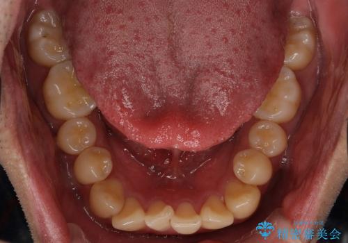 受け口　八重歯　前歯のがたがた　前歯が中に引っ込んでいるの治療前
