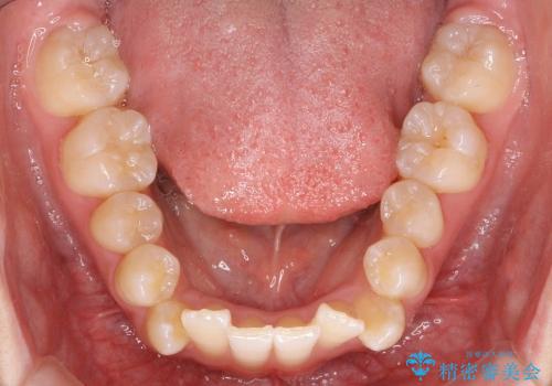 歯を抜かない矯正　インビザラインで　前歯のでこぼこの治療前