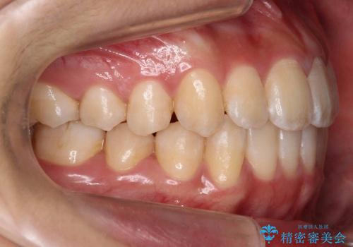 歯を抜かない矯正　インビザラインで　前歯のでこぼこの治療後