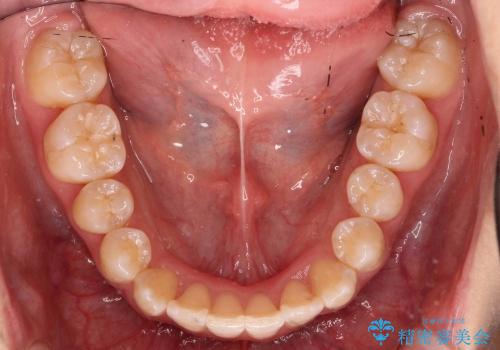 歯を抜かない矯正　インビザラインで　前歯のでこぼこの治療後