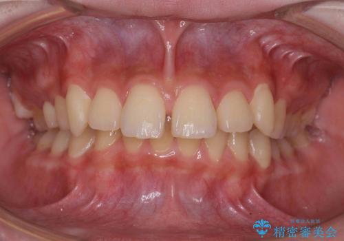 抜かない矯正　出っ歯を大きく下げました　乳歯が残って異所萌出　奥歯のすれ違い咬合の治療前