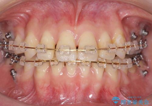 20代女性　八重歯　奥歯の反対咬合　前歯のがたがた　急速拡大装置での治療中