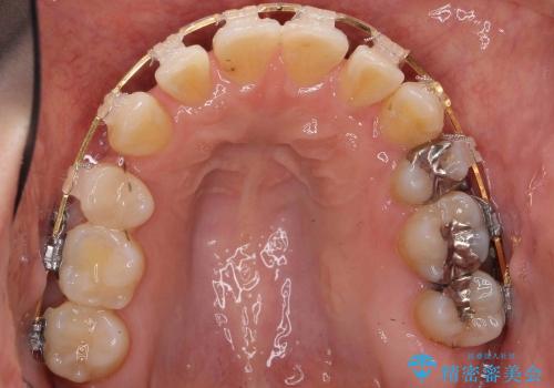 20代女性　八重歯　奥歯の反対咬合　前歯のがたがた　急速拡大装置での治療中
