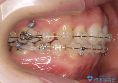 30代女性　出っ歯　奥歯のかみ合わせのずれ　上のみ抜歯の治療中