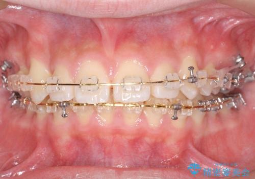 抜かない矯正　出っ歯を大きく下げました　乳歯が残って異所萌出　奥歯のすれ違い咬合の治療中