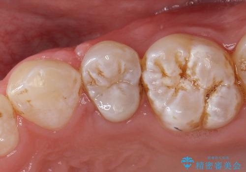 セラミックインレーによる虫歯治療の症例 治療前