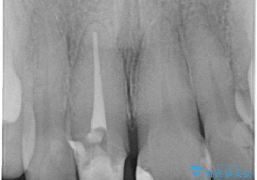 30代女性　部分矯正を駆使して歯ぐきのラインと歯軸をそろえるの治療中