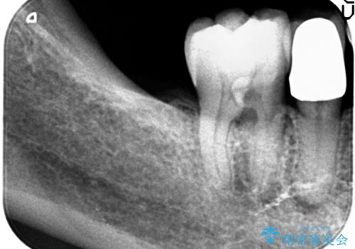 40代女性　奥歯のインプラントと分岐部病変の処置(ルートセパレーション)の治療前