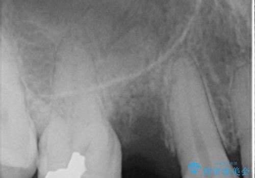 30代男性　歯が無い→インプラントで回復　サイナスソケットリフトの併用の治療前