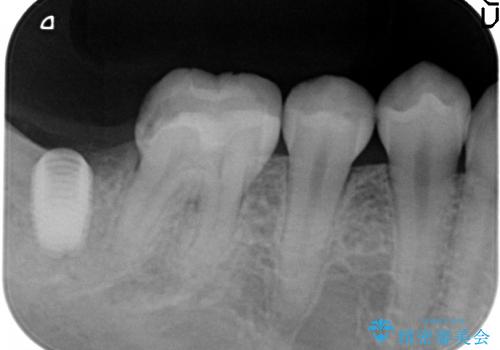 30代女性　奥歯のショートインプラントの治療中