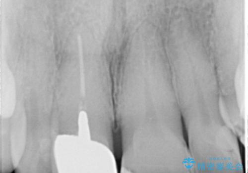 30代女性　部分矯正を駆使して歯ぐきのラインと歯軸をそろえるの治療前