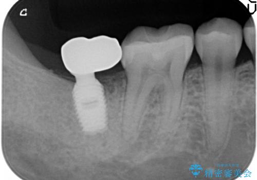 30代女性　奥歯のショートインプラントの治療後