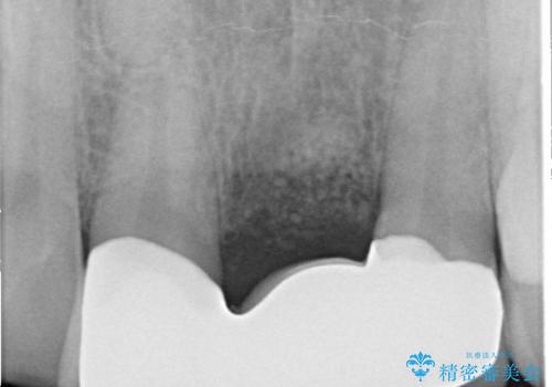 前歯のブリッジ治療　部分矯正を併用して歯茎の形態をコントロールの治療後