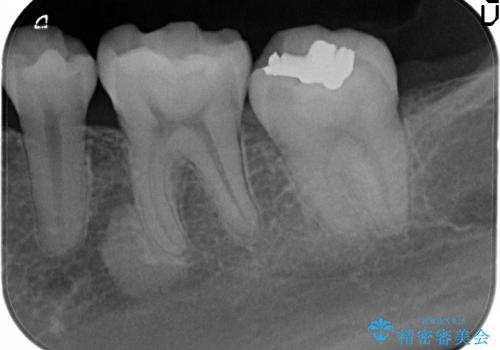 [奥歯を白く]　コンポジットレジン・銀歯のやりかえの治療前