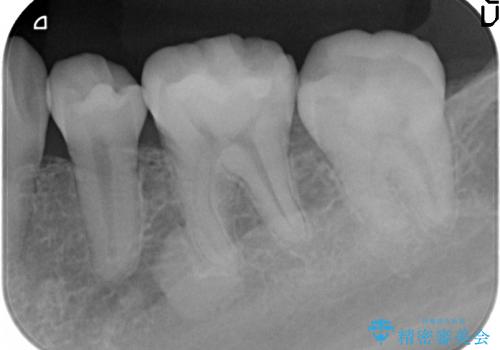 [奥歯を白く]　コンポジットレジン・銀歯のやりかえの治療後