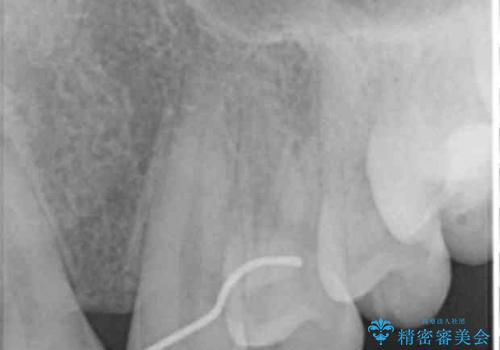 尖った犬歯を目立たなくする　ラミネートベニア修復　他院の矯正治療で前歯の隙間が残ったのを回復の治療前