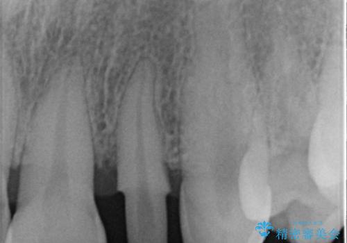30代女性　前歯の限局的な歯周病を治療する②～被せものの製作の治療中