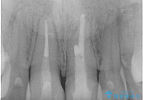前歯の根管治療(イニシャルトリートメント)の症例 治療後