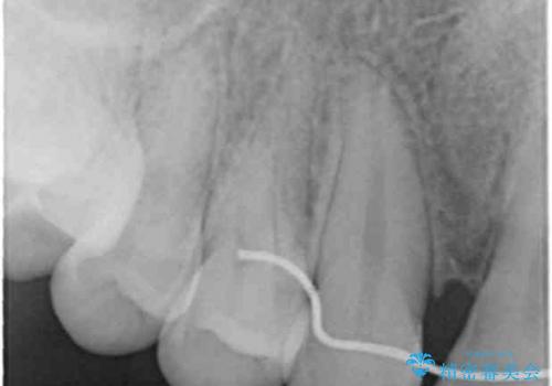 尖った犬歯を目立たなくする　ラミネートベニア修復　他院の矯正治療で前歯の隙間が残ったのを回復の治療前