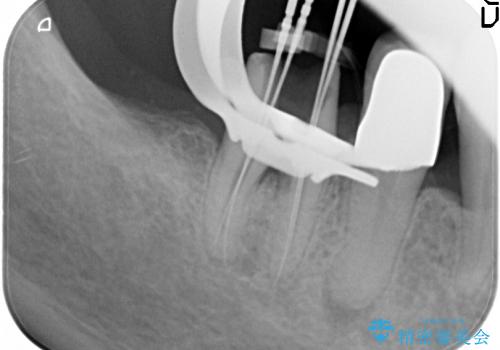 40代女性　奥歯のインプラントと分岐部病変の処置(ルートセパレーション)の治療中