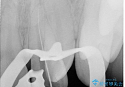 [外傷歯の治療] ころんでぶつけて折れた前歯の審美回復の治療前